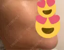 ピコレーザートーニング（美白・肝斑） / ピコフラクショナルレーザー（毛穴・ニキビ跡） 東京シルククリニック 新宿院 BEFORE サムネイル用