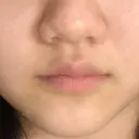 ヒアルロン酸注入（唇） / ボトックス（口角） クリニックA.O. BEFORE サムネイル用