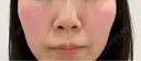 鼻尖形成（切開） / 鼻中隔延長（切開） / 軟骨移植 / 眉間プロテーゼ eクリニック 福岡院 BEFORE サムネイル用
