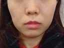 糸リフト / 脂肪吸引（顔） / あご下筋肉縛り LUHO（ルホ）美容外科 BEFORE サムネイル用