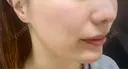 鼻翼基部形成（貴族手術） eクリニック 富山駅前院 BEFORE サムネイル用