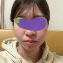 オンダリフト LIGHT CLINIC 【ライトクリニック】 名古屋院 BEFORE サムネイル用