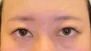 脂肪吸引（顔） / 目尻切開 / タレ目形成・グラマラスライン（埋没） LOUIS CLINIC 二子玉川院【ルイクリニック】 BEFORE サムネイル用