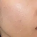 ニードルRF（ポテンツァなど） ルラ美容クリニック 広島院 BEFORE サムネイル用