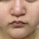 脂肪溶解注射（顔） ミニマムスキンクリニック池袋 BEFORE サムネイル用