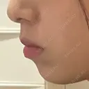 ヒアルロン酸注入（あご） / ボトックス（エラ・小顔） ルラ美容クリニック 名古屋本院 BEFORE サムネイル用