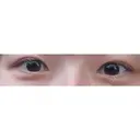 二重切開 / 眼瞼下垂（切開） / 上まぶたたるみ取り eクリニック 福岡院 BEFORE サムネイル用