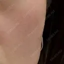 ピーリング（ハリ・ツヤ） ジュエルクリニック 恵比寿院 BEFORE サムネイル用