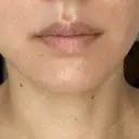 糸リフト 城本クリニック 豊橋院 BEFORE サムネイル用