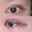 二重埋没 / 目頭切開 / 上まぶたの脂肪取り 9BeautyClinic BEFORE サムネイル用