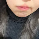 ボトックス（あご） / ヒアルロン酸注入（あご） / ヒアルロン酸注入（唇） HAAB×DREAM BEAUTY CLINIC 大阪梅田院 BEFORE サムネイル用