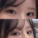 目頭切開 東京シンデレラ美容外科 池袋院 BEFORE サムネイル用