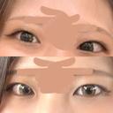 二重埋没 / 目頭切開 BITO BEAUTY CLINIC BEFORE サムネイル用