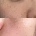ピーリング（ニキビ・毛穴） / イオン導入 / ルメッカ ルラ美容クリニック 札幌本院 BEFORE サムネイル用