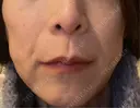 ハイフ（顔） 共立美容外科 大阪本院 BEFORE サムネイル用