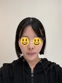 隆鼻術 / 鼻尖形成（切開） / 鼻中隔延長（切開） / 小鼻縮小（切開） / 軟骨移植 / 鼻修正 / 鼻孔縁下降 シンデレラ＆ダヴィンチクリニック BEFORE サムネイル用