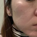 ピーリング（ニキビ・毛穴） / LDM・インテンスウルトラ ライズワン美容皮膚科クリニック BEFORE サムネイル用