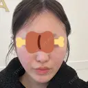 糸リフト A CLINIC（エークリニック） 大阪院 BEFORE サムネイル用