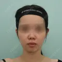 脂肪吸引（顔） / ジョールファット除去 / ボトックス（エラ・小顔） WOM CLINIC GINZA （ワム クリニック ギンザ） BEFORE サムネイル用