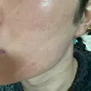 フラクショナルレーザー（毛穴・ニキビ跡） ルラ美容クリニック 大阪本院 BEFORE サムネイル用