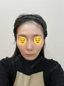 ソフウェーブ アンリクリニック 名古屋院 BEFORE サムネイル用