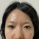 二重埋没 東京シンデレラ美容外科 池袋院 BEFORE サムネイル用