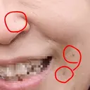 ほくろ・いぼ切除（肌） CLINIC W BEFORE サムネイル用