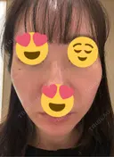 毛穴洗浄（ハイドラフェイシャルなど） / ピコレーザートーニング（美白・肝斑） 表参道ウィズ・クリニック BEFORE サムネイル用