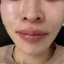 デンシティ 東京シルククリニック 新宿院 BEFORE サムネイル用