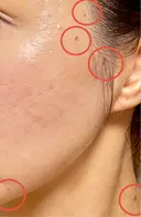 ほくろ・いぼ切除（肌） 新宿美容外科クリニック 新宿院 BEFORE サムネイル用