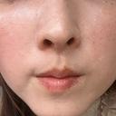 光治療（フォトフェイシャルなど） BITO BEAUTY CLINIC BEFORE サムネイル用