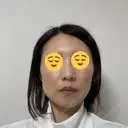 ボトックス（エラ・小顔） TCB東京中央美容外科 神戸院 BEFORE サムネイル用