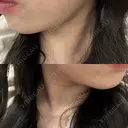 ボトックス（エラ・小顔） / ボトックス（肩） Tokyo Tensei Clinic 新宿院 BEFORE サムネイル用