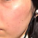 ピーリング（ニキビ・毛穴） / フラクショナルレーザー（毛穴・ニキビ跡） RIN BEAUTY CLINIC BEFORE サムネイル用