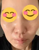 肌育注射（ジュベルックなど） 城本クリニック 豊橋院 BEFORE サムネイル用