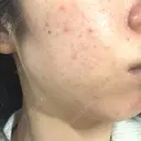 毛穴洗浄（ハイドラフェイシャルなど） / ルメッカ おおかみ美容のクリニック 新宿院 BEFORE サムネイル用