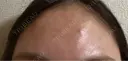リジュラン CZEN CLINIC 銀座院 BEFORE サムネイル用