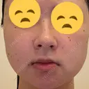 ほくろ・いぼ除去レーザー（肌） Fellez Clinic【フェルズクリニック】 BEFORE サムネイル用