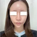 鼻尖形成（切開） / 軟骨移植 / 鼻修正 / 鼻孔縁挙上 / その他（鼻） WOM CLINIC GINZA （ワム クリニック ギンザ） BEFORE サムネイル用