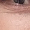 リジュラン 千葉美容外科アイビークリニック BEFORE サムネイル用