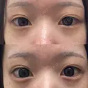 ヒアルロン酸注入（涙袋） AYANAフィラーズクリニック 渋谷院 BEFORE サムネイル用