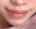 口唇縮小術 Stand by Beauty Clinic BEFORE サムネイル用
