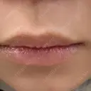 アートメイク（唇） TRUE DESIGN CLINIC BEFORE サムネイル用