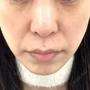 糸リフト / ボトックス（エラ・小顔） / ボトックス（額） / ボトックス（バニーライン） / ピコレーザートーニング（美白・肝斑） / ショッピングリフト APスキンクリニック銀座 BEFORE サムネイル用