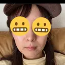 ボトックス（エラ・小顔） / ボトックス（口角） DMTC美容皮膚科 大宮院 BEFORE サムネイル用