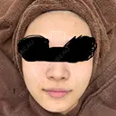 肌育注射（ジュベルックなど） CHARIS BEAUTY CLINIC BEFORE サムネイル用