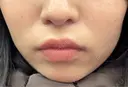 ボトックス（あご） / ボトックス（エラ・小顔） / ボトックス（口角） 上野注入クリニック BEFORE サムネイル用