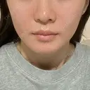 ヒアルロン酸注入（頬） / ヒアルロン酸注入（鼻翼基部） KIMI CLINIC 形成・美容外科 BEFORE サムネイル用