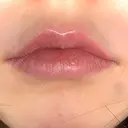 ヒアルロン酸注入（唇） HAAB×DREAM BEAUTY CLINIC 大阪梅田院 BEFORE サムネイル用