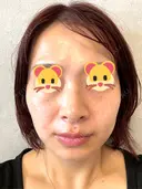 ボトックス（エラ・小顔） / ルメッカ ルラ美容クリニック 横浜院 BEFORE サムネイル用